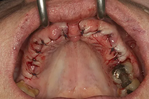 Site sutured closed after implant surgery