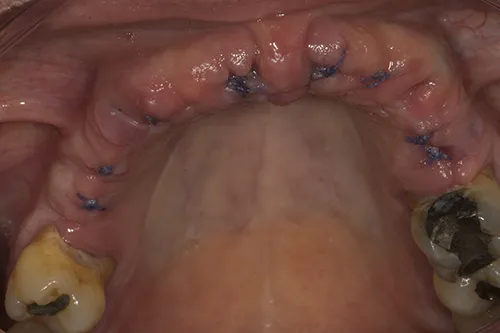Implant surgery site 10 days later prior to suture removal