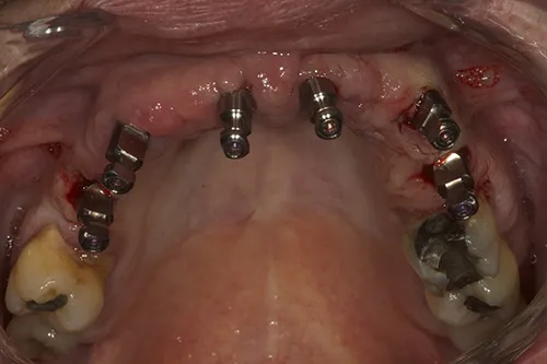 Impression posts placed showing angulation of implant fixtures