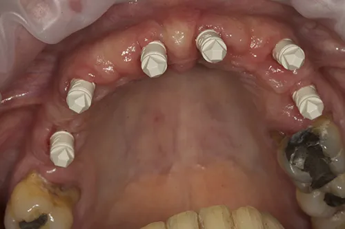 Scan bodies connected to implant fixtures prior to digital impressions