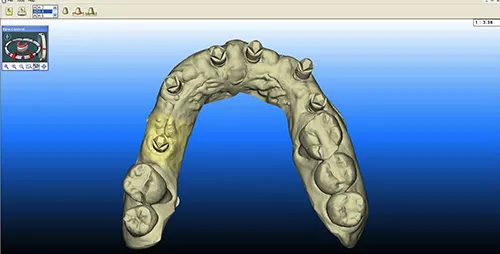 Digital impression of scan bodies in situ