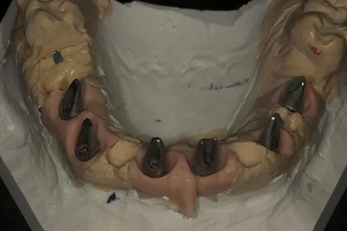Traditional model in stone fabricated with soft tissue model showing permanent abutments in situ