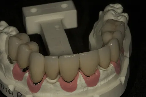 iTero model showing the right-hand side of the bridge