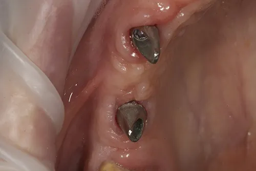 Implant abutments tightened in place upper right hand side