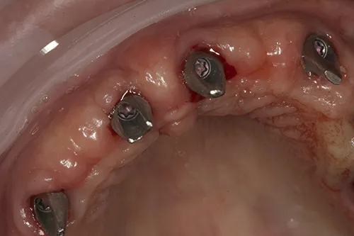 Implant abutments for upper fronts tightened in place