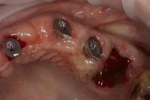 Implant abutments tightened upper left hand side and tooth extracted