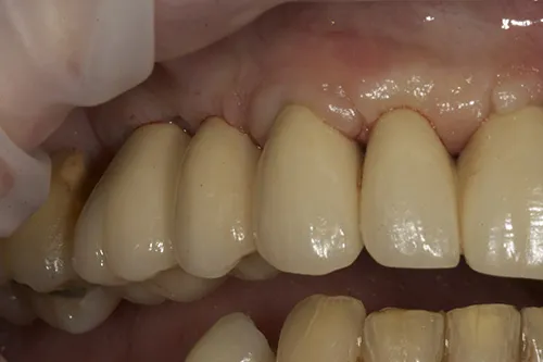 Final bridgework cemented upper right hand side