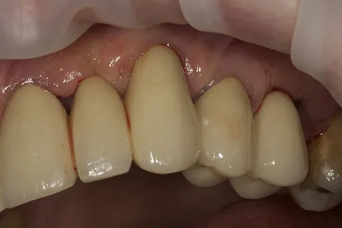 Final bridgework fitted upper left hand side