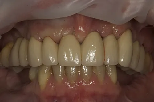 After treatment: Replacing failing upper teeth with a fixed implant bridge