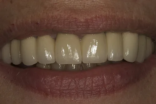 Smile line of fitted bridge
