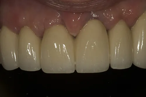 2 week review of bridge in situ