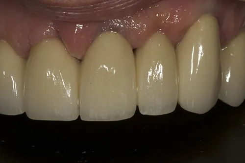 2 week review up close left hand side