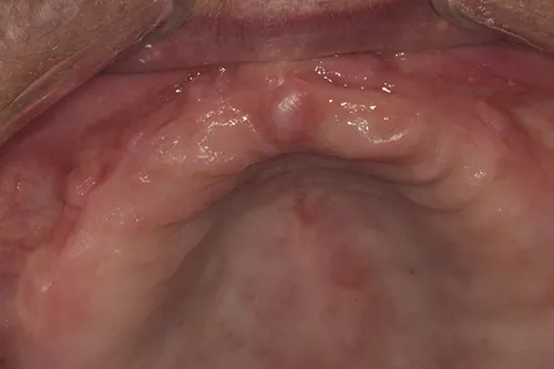 Before treatment: A denture held in place by four implants