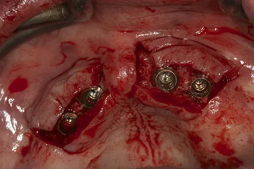 4 implant fixtures placed in situ