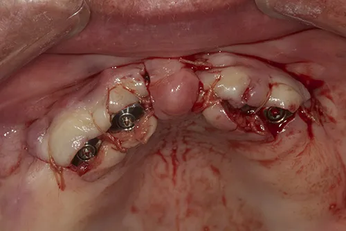 Surgical implant site closed immediately postoperatively