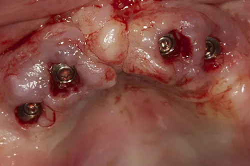 Implant fixtures exposed after soft tissue healing of 8 weeks