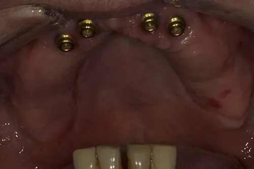 Healed locator abutments and residual lower teeth