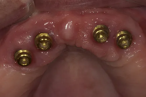 Close up of healed locator abutments