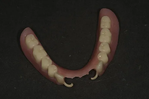 New lower denture fabricated