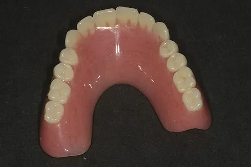 Over denture showing minimal coverage of palate