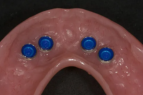 Close up of fit surface locator females within overdenture