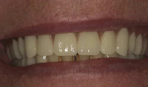 After treatment: A denture held in place by four implants