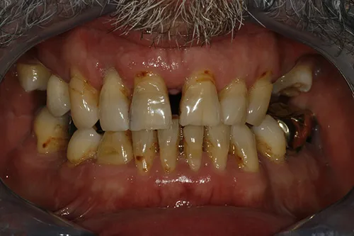 Before: failing upper and lower teeth