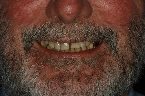 Smile zone of failing teeth