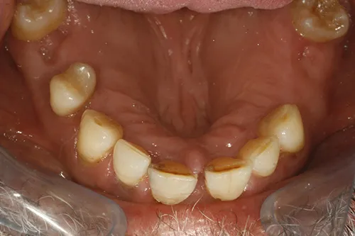 Mirror view of failing teeth