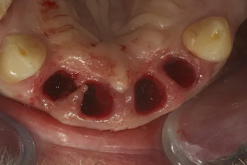 Staged extraction of failing teeth