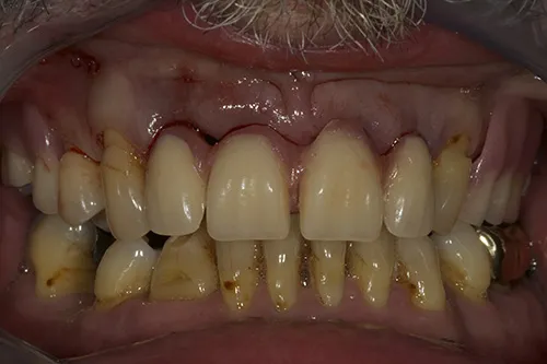 Temporary denture fitted immediately after extraction of failed teeth
