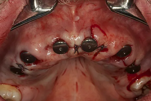 Implants placed and sites sutured closed