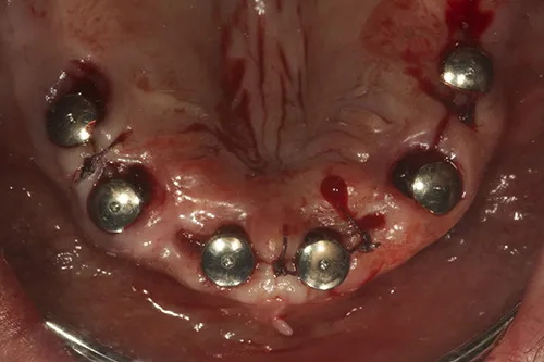 Mirror view of implants in situ