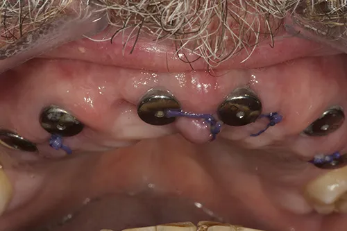 Healed implant sites