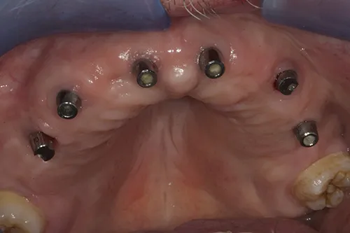 Permanent SynCone abutments fitted and healed