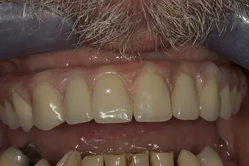 After: the removable implant bridge at the two-week review