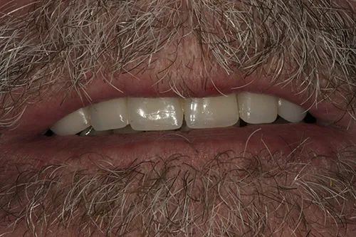 Smile of fitted bridge