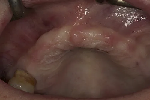 Before treatment: An upper implant overdenture with bone regeneration