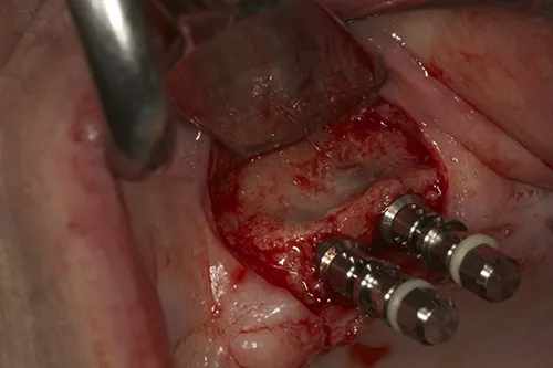 Left hand side implants placed