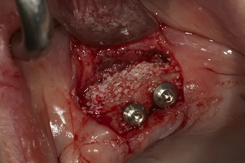 Left hand side implants in situ with guided bone regeneration