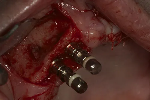 Right hand side implants placed
