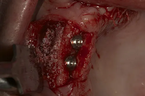 Right hand side implants placed with guided bone regeneration