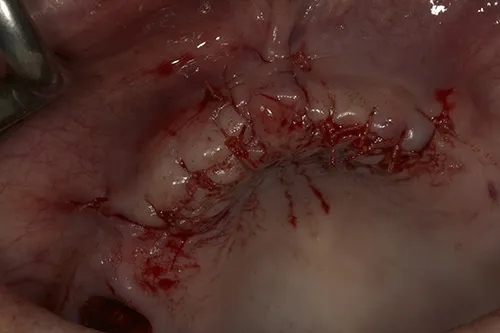 Surgical implant site closed