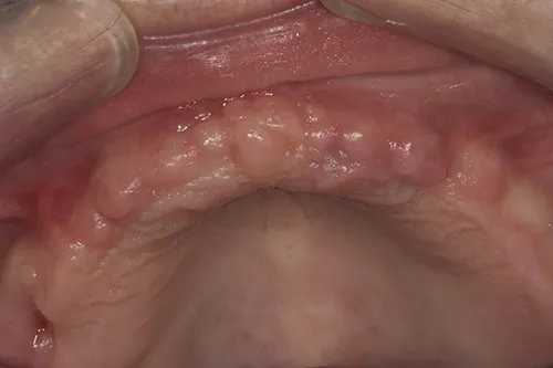 Implant site healed 10 weeks later