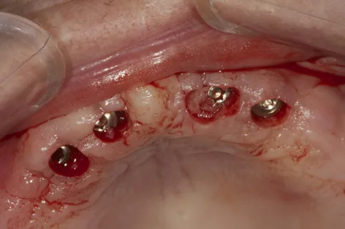Implant fixtures exposed