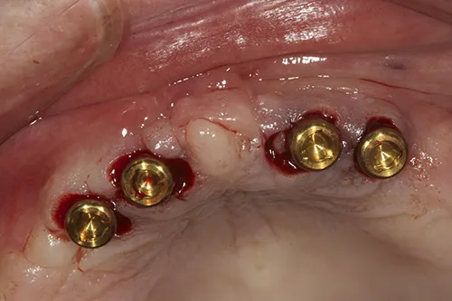 Permanent overdenture abutments placed