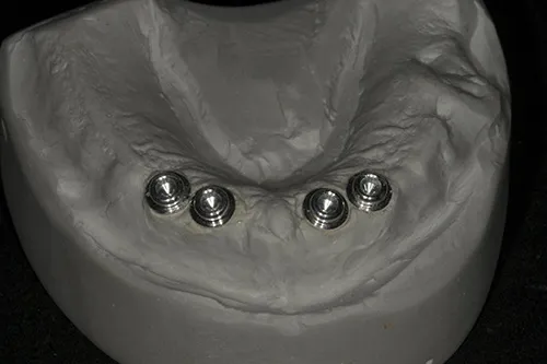 Implant overdenture model