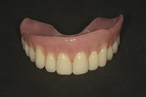 Implant overdenture fabricated