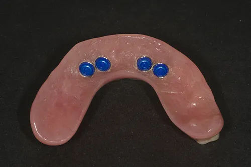 Fit surface of implant overdenture