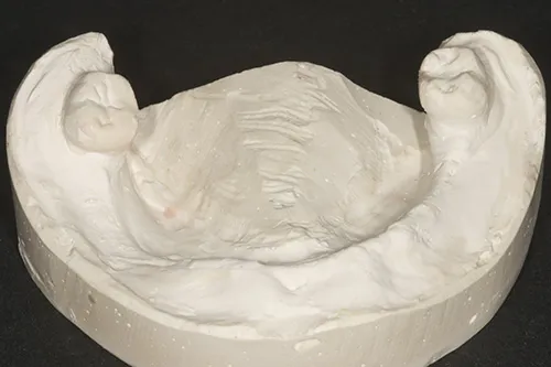 Lower denture model